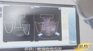皮肤CT检测痘痘成因